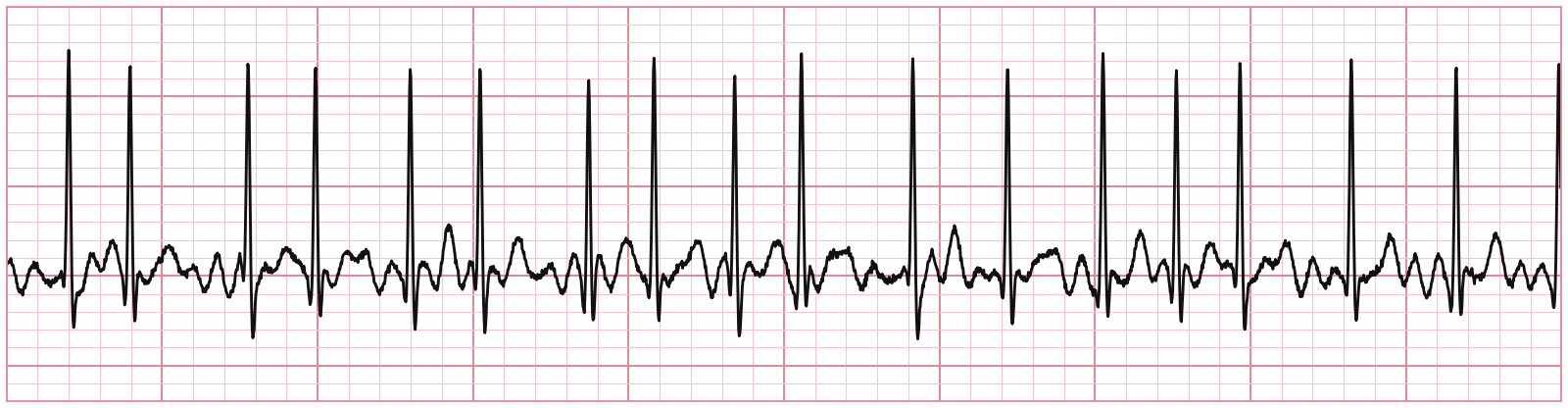 ECG rhythm strip for a clinical teaching question